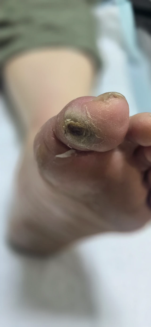 Initial Visit — 3-Month-Old Diabetic Foot Ulcer, Before Debridement