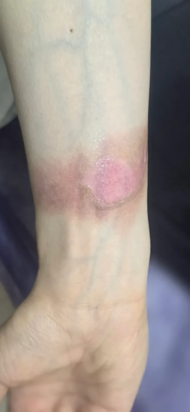Visit 1 — first- and second-degree steam burn