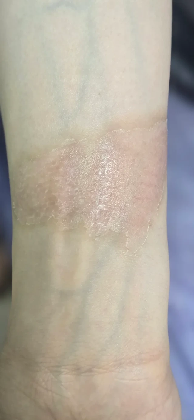 Visit 3 — the surface has dried and new skin has formed