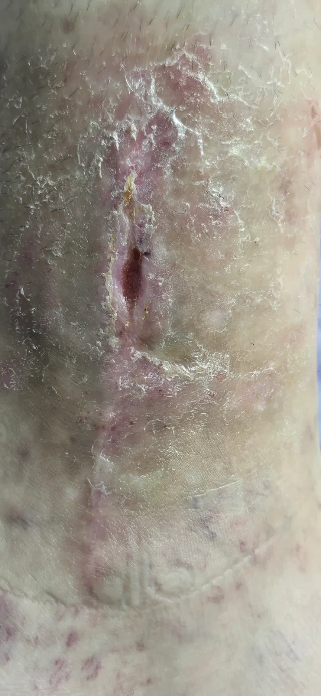 Visit 13 — closed, with only the scar left