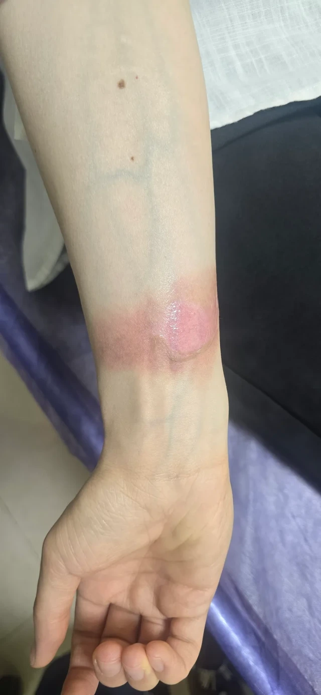 Visit 1 — first- and second-degree steam burn