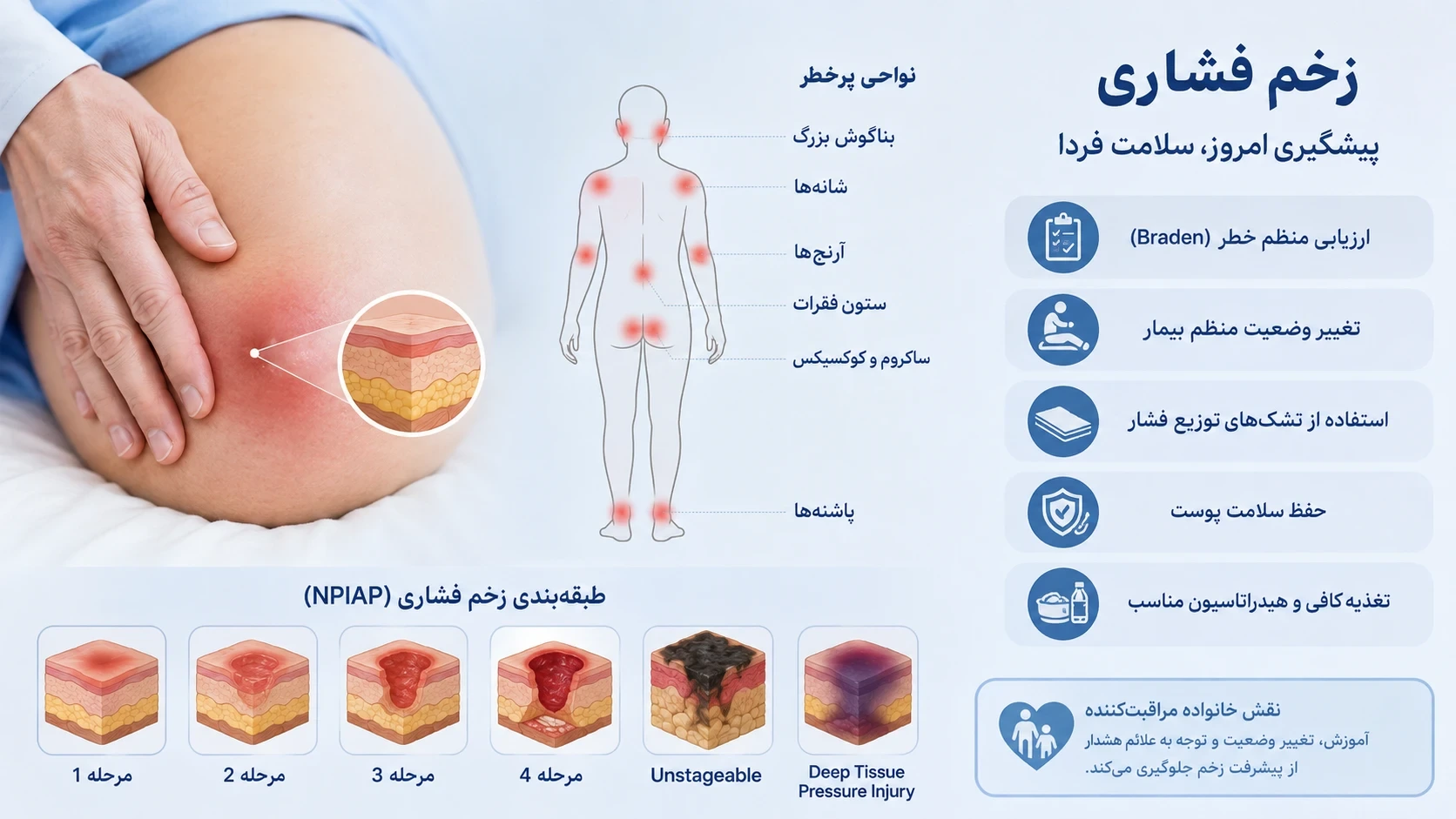 زخم بستر (فشاری): پیشگیری، طبقه‌بندی و درمان