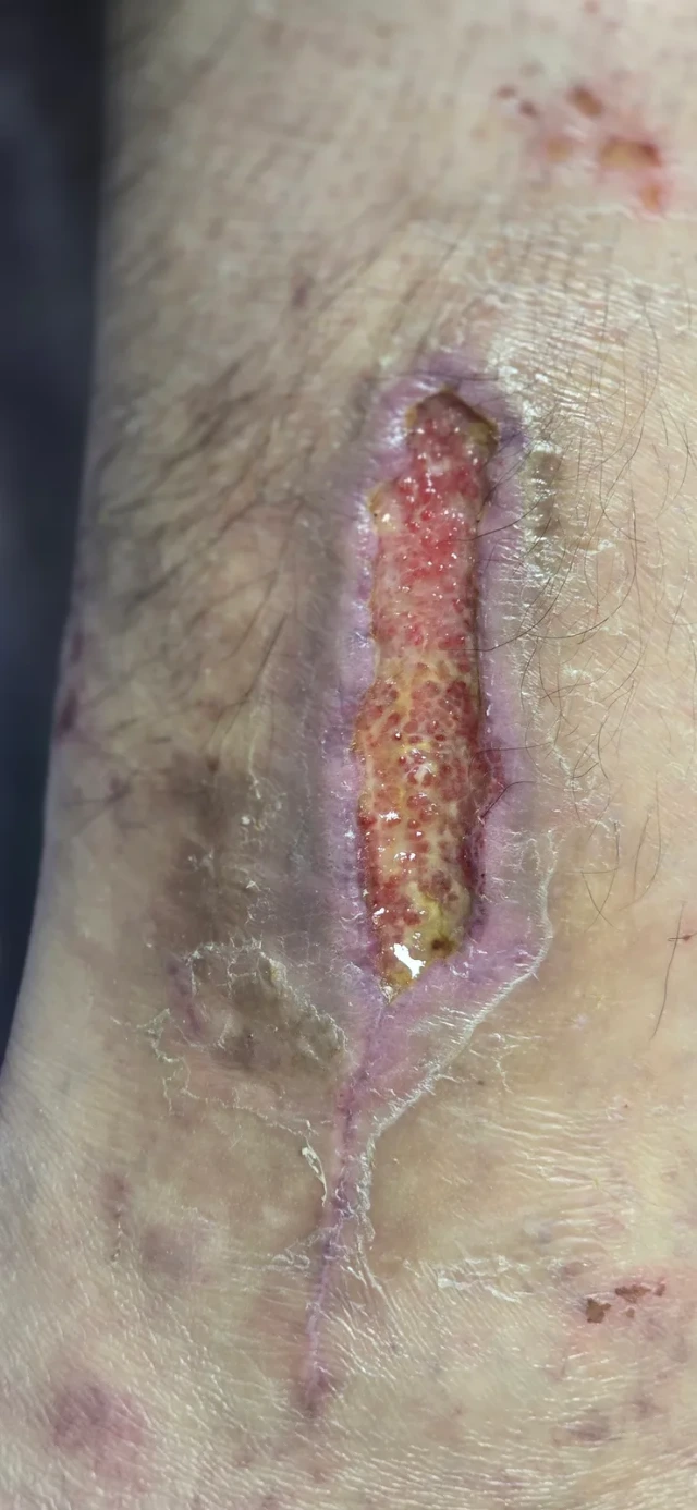 Visit 2 — a cleaner bed, repair tissue starting to form