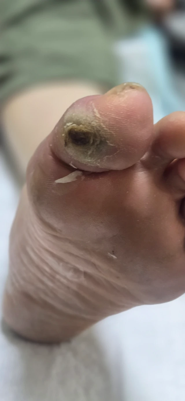 Initial Visit — 3-Month-Old Diabetic Foot Ulcer, Before Debridement