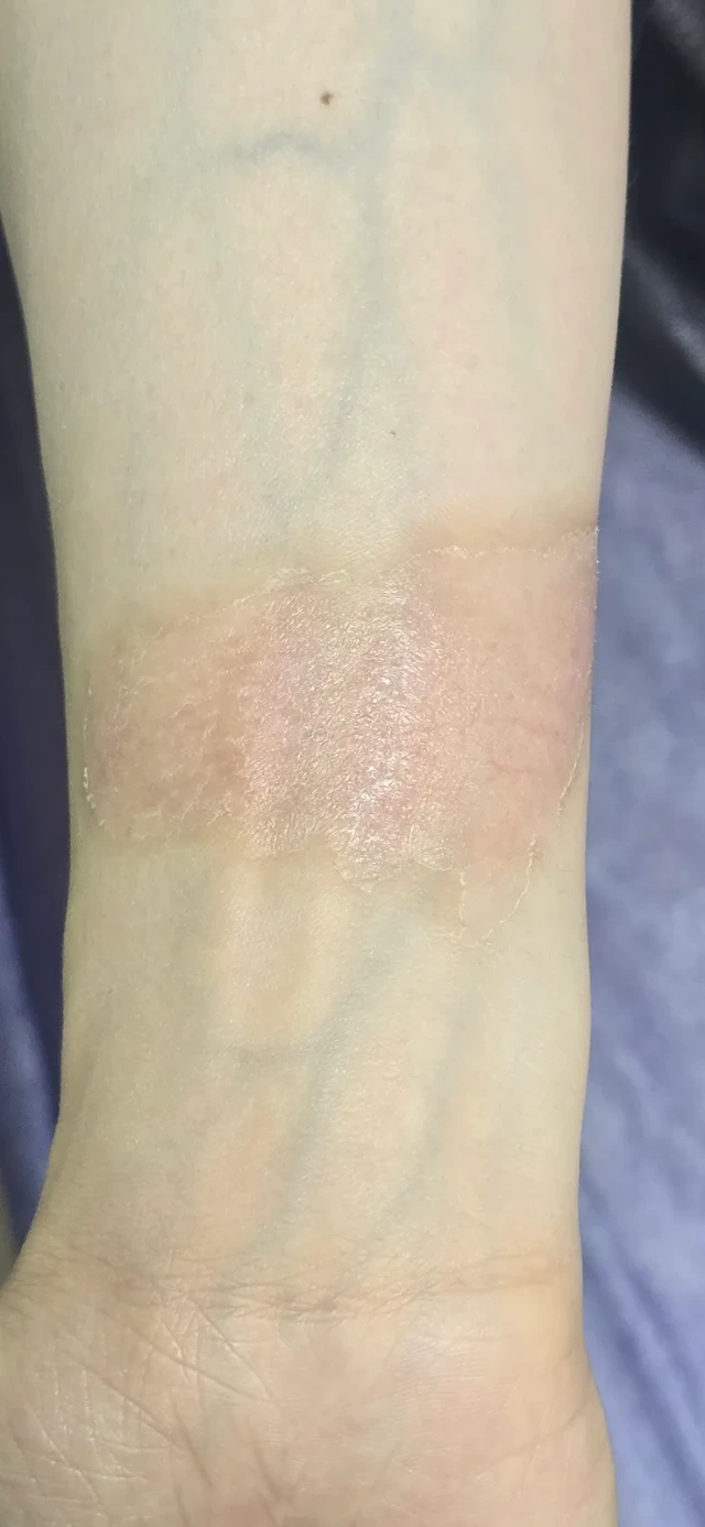Visit 3 — the surface has dried and new skin has formed