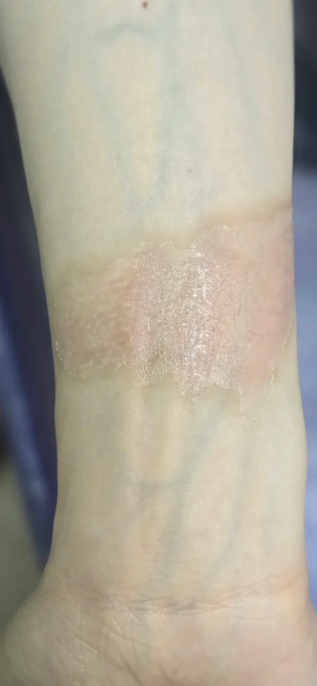 Visit 3 — the surface has dried and new skin has formed