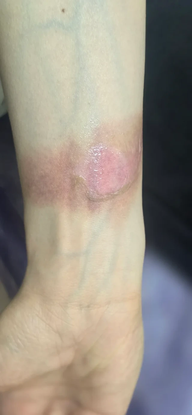 Visit 1 — first- and second-degree steam burn