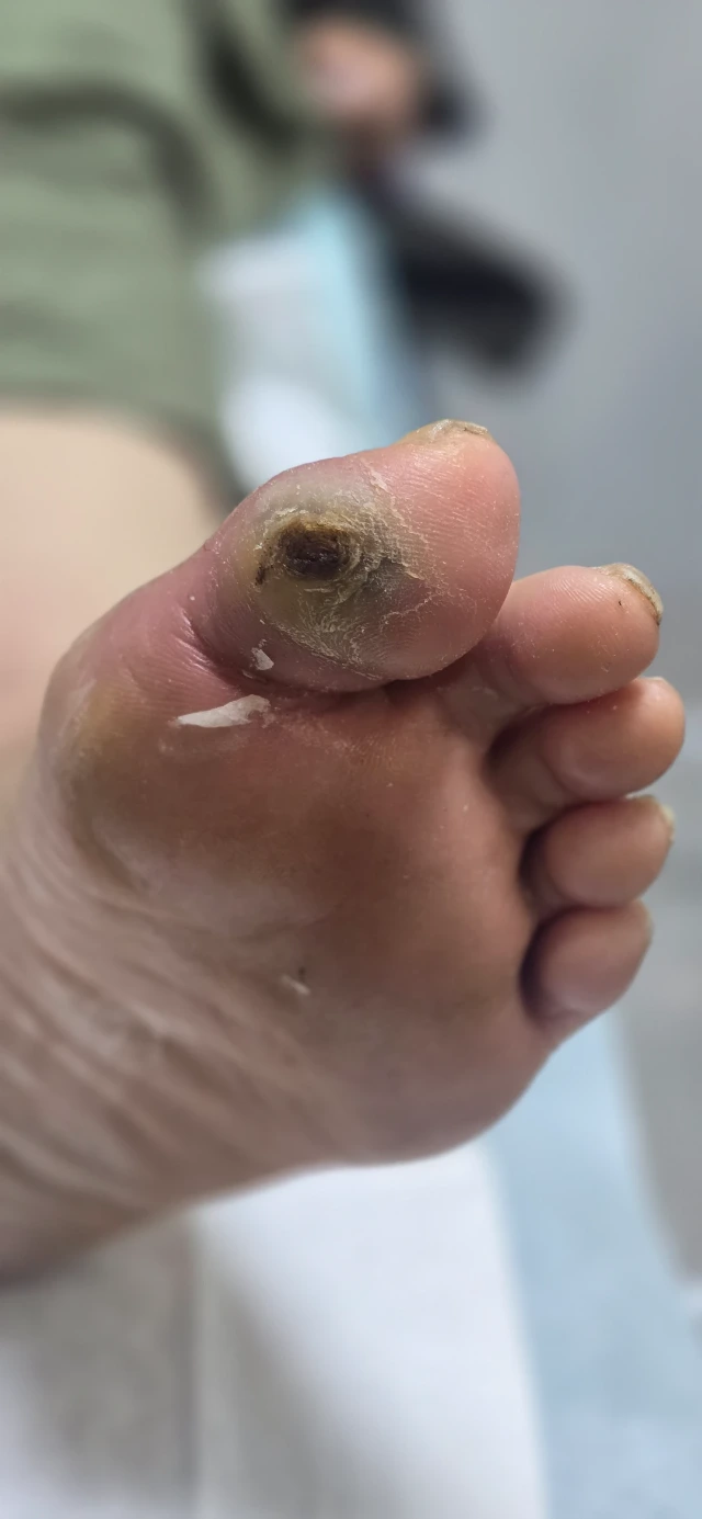 Initial Visit — 3-Month-Old Diabetic Foot Ulcer, Before Debridement