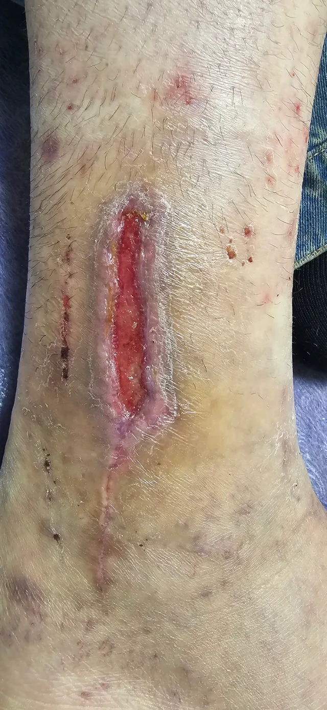 Visit 5 — healthy repair tissue along the whole wound