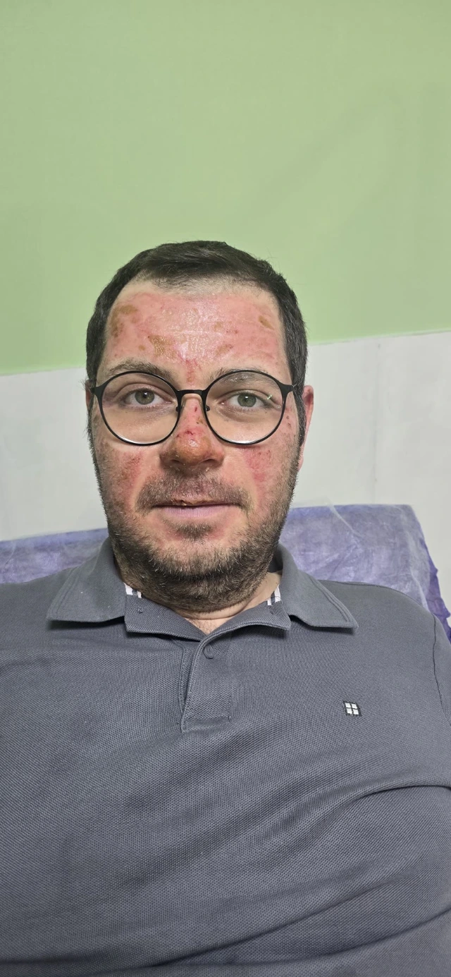 Session four, face: the skin has evened out; only a few pale patches remain