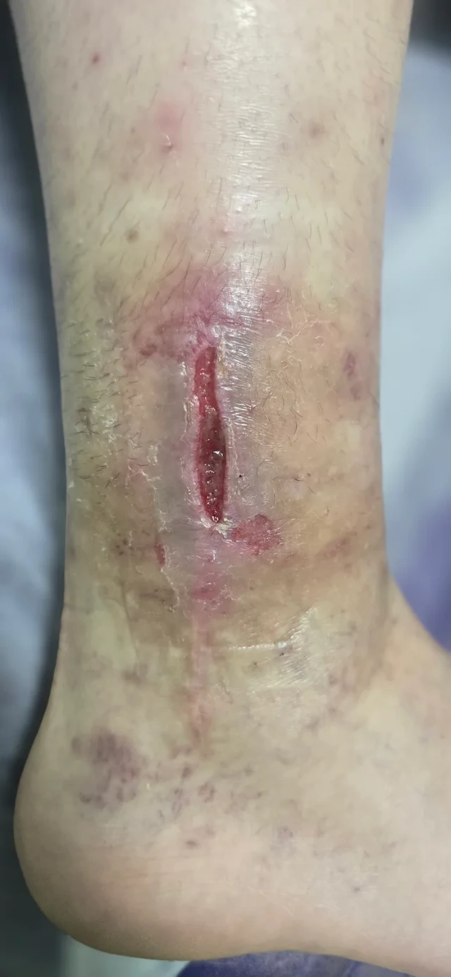 Visit 7 — the wound has narrowed and the edges have drawn together
