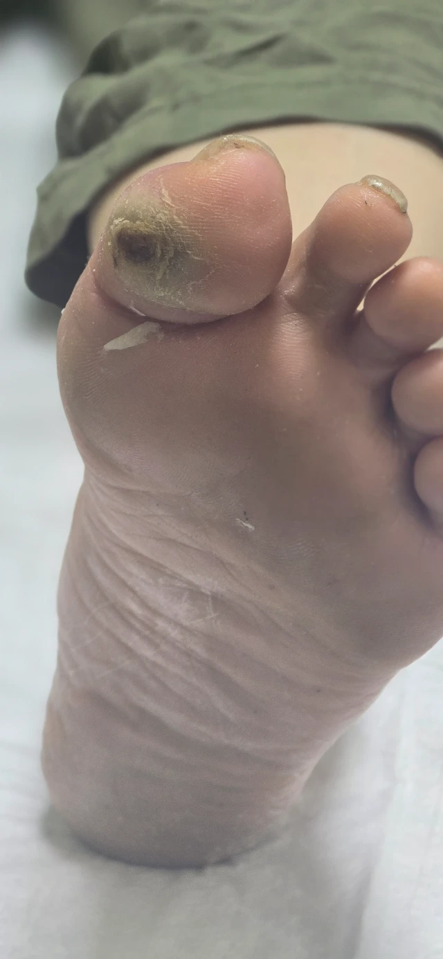 Initial Visit — 3-Month-Old Diabetic Foot Ulcer, Before Debridement