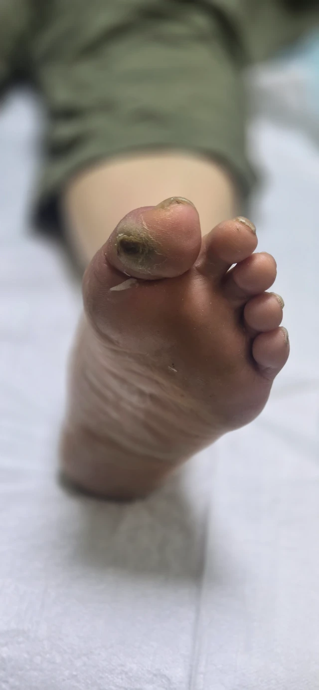 Initial Visit — 3-Month-Old Diabetic Foot Ulcer, Before Debridement