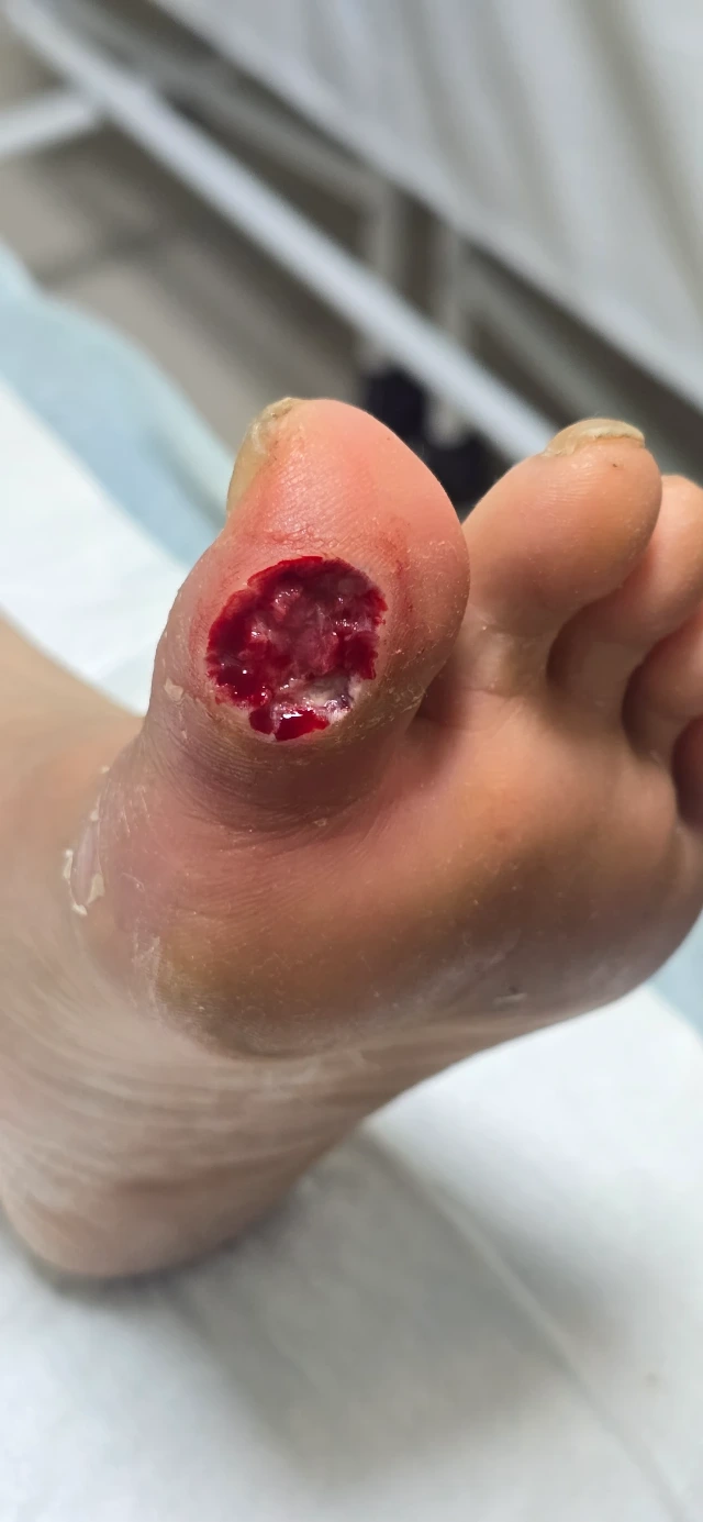 Initial Visit — 3-Month-Old Diabetic Foot Ulcer, After Debridement
