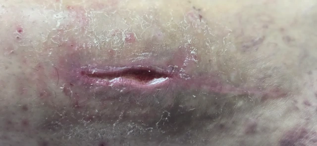 Visit 9 — the wound is down to a narrow slit