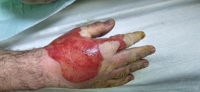 Session one, back of the hand: an open, moist surface with yellow separated skin over the fingers
