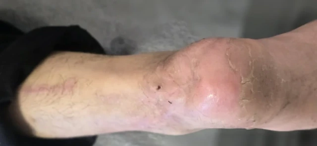 Heel Wound and Skin Necrosis Treatment After Accident and Surgery