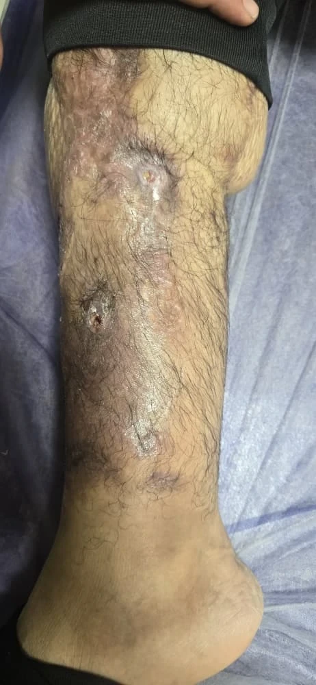 Negative Pressure Wound Therapy (NPWT) for Faster Wound Healing