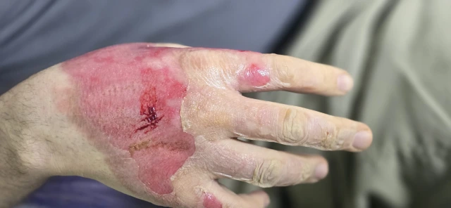 Session four, back of the hand: new pink skin now covers almost the whole area
