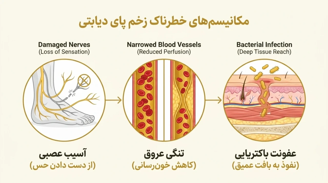 نمودار سه عامل خطر در زخم پای دیابتی: آسیب عصبی، کاهش خونرسانی و عفونت