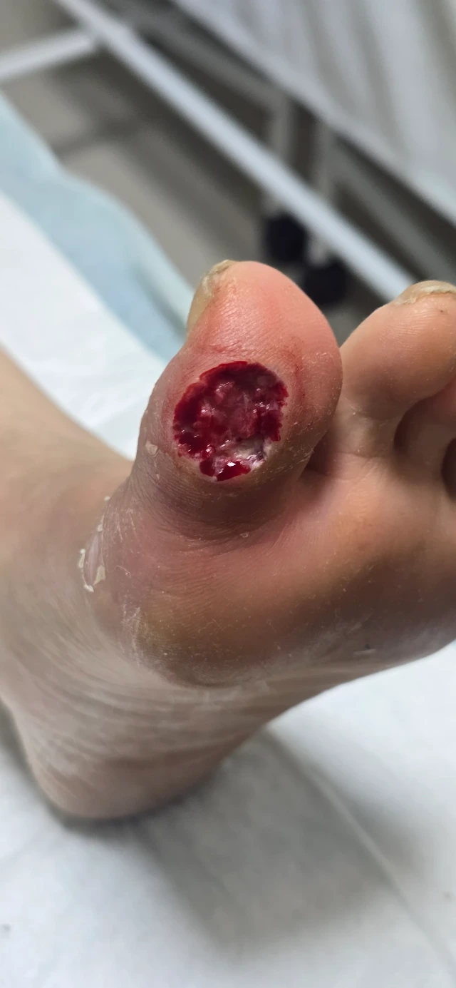 Initial Visit — 3-Month-Old Diabetic Foot Ulcer, After Debridement