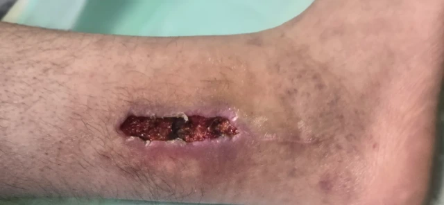 Visit 1 — the separated wound, dead tissue