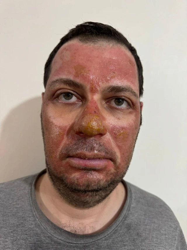 Session one, face: widespread redness across the cheeks and forehead, with yellow crusting on the nose