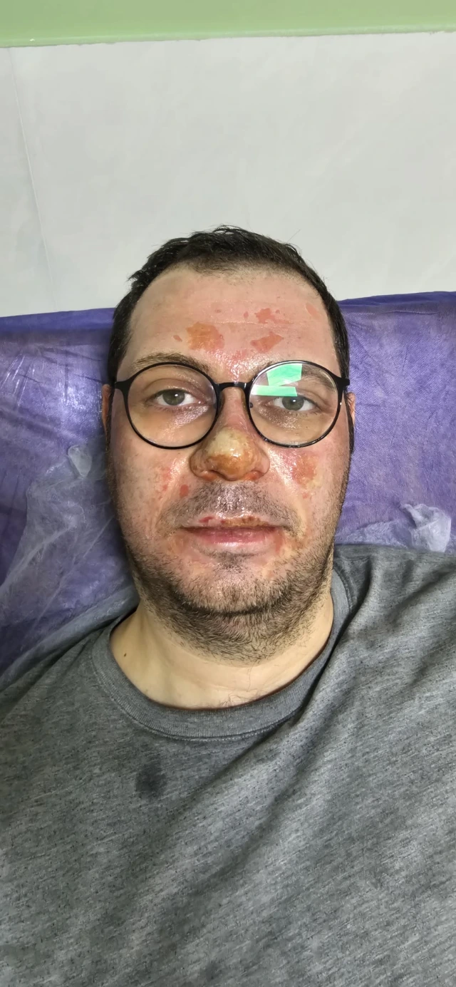 Session three, face: the inflammation has subsided; dry crusts remain on the nose and chin