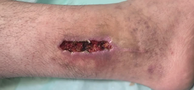 Visit 1 — a closer view of the same wound
