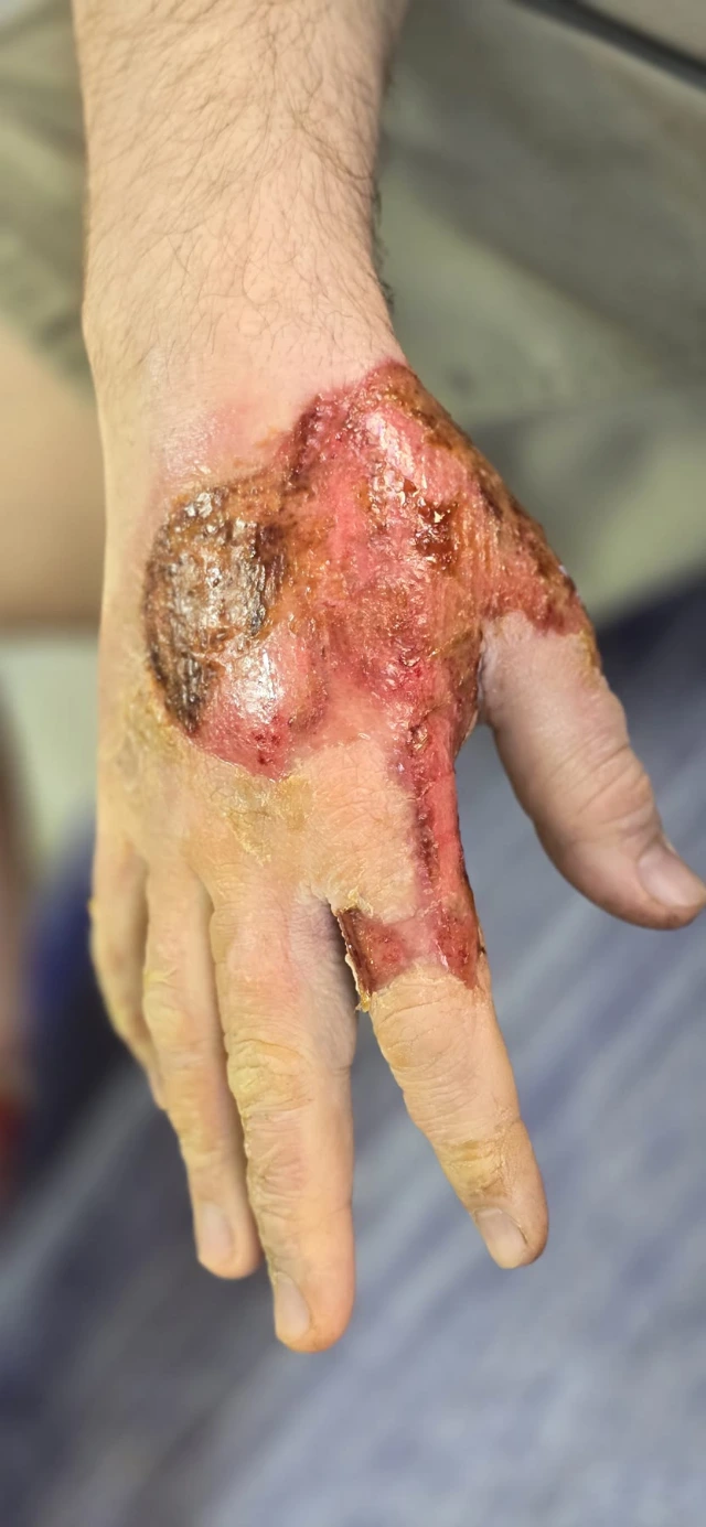 Session three, back of the hand: the area has drawn in and a yellow-brown layer has settled over it