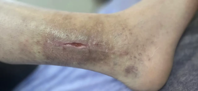 Visit 12 — the wound has almost closed