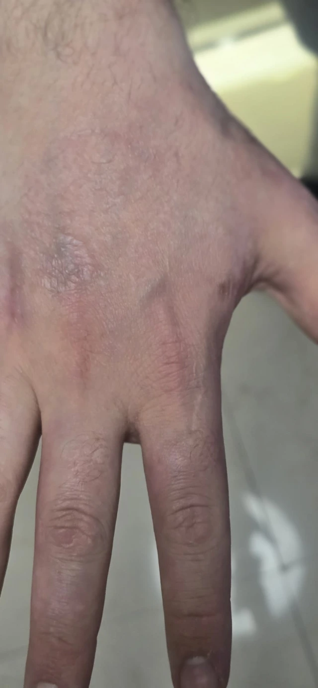 End of the course, back of the hand: skin closed and even in tone, with no open wound